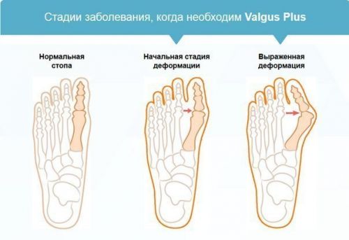 Фиксатор Valgus Pro для косточки большого пальца ноги. Вид 2 Фиксатор Valgus Pro для косточки большого пальца ноги. Вид 2