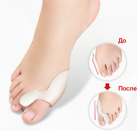 Фиксатор Valgus Pro для косточки большого пальца ноги. Вид 5