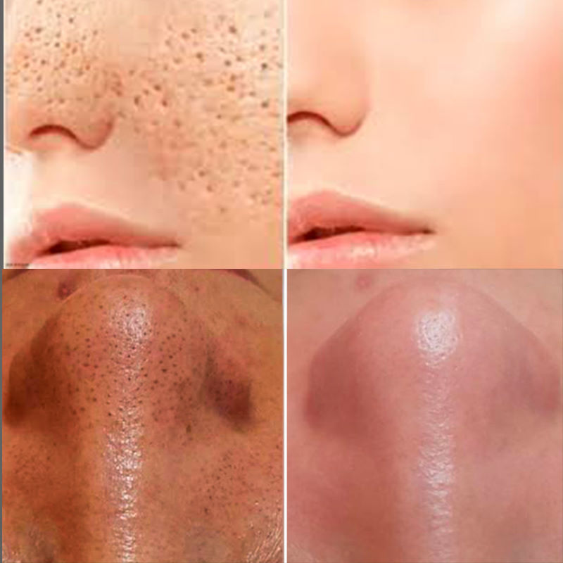 Зелёная маска от прыщей Green Acne Stick. Вид 4 Зелёная маска от прыщей Green Acne Stick. Вид 4